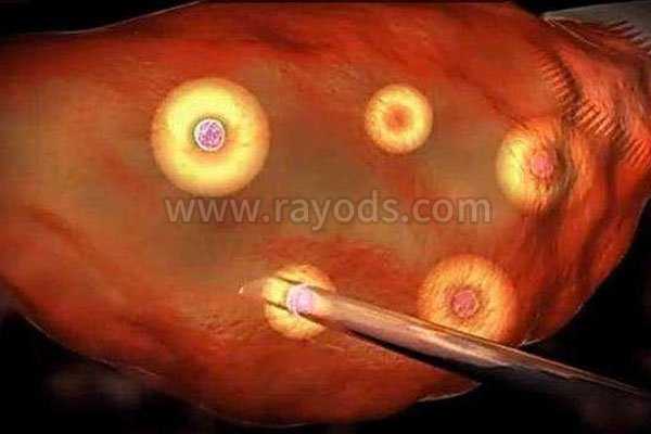 卵巢早衰供卵后保胎指南及绝经后试管可行性